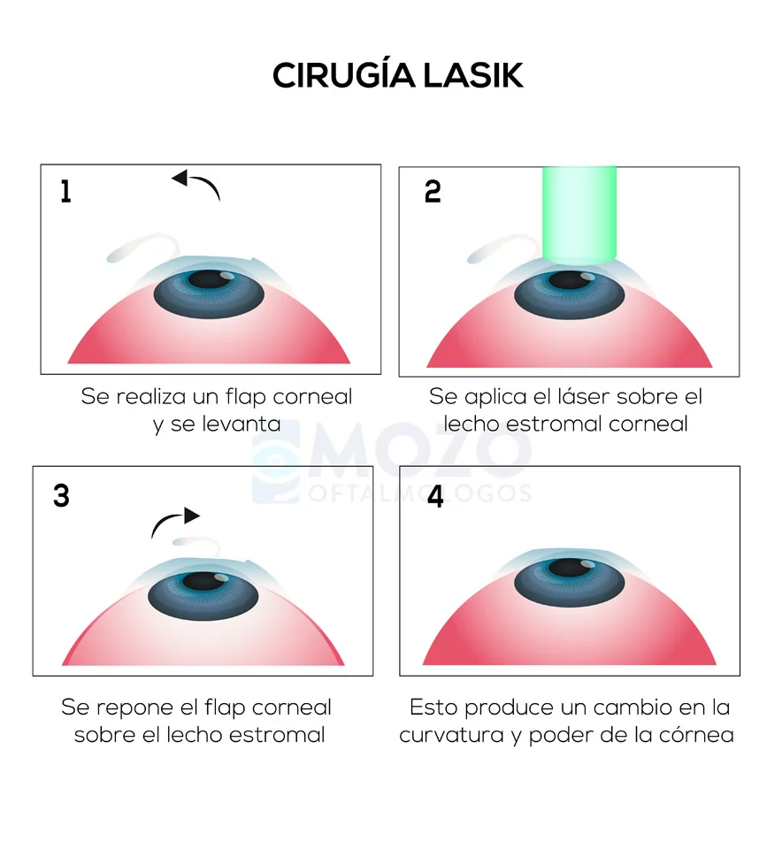 Guía Para La Cirugía Ocular Y Visual Lasik – SAKN