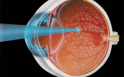 La Diabetes Mellitus y la retina… ¿Cómo se relacionan?